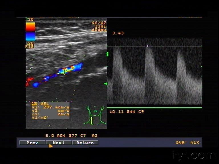 颈内动脉狭窄(典型图像) - 超声医学讨论版 - 爱爱医