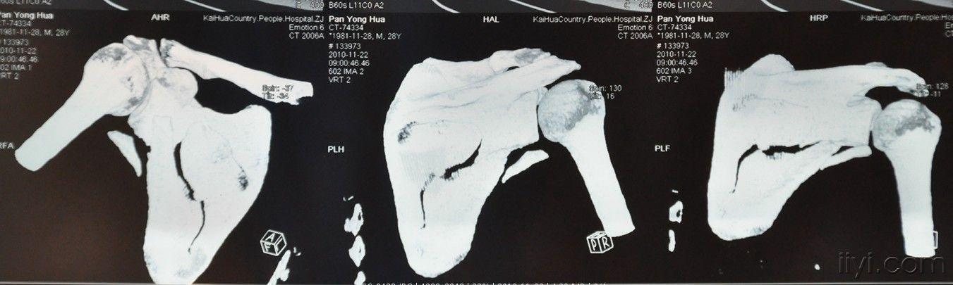 右肩胛骨粉碎性骨折