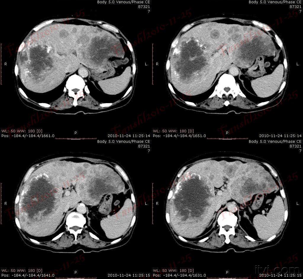 经典病例(一)----肝脏ct病例