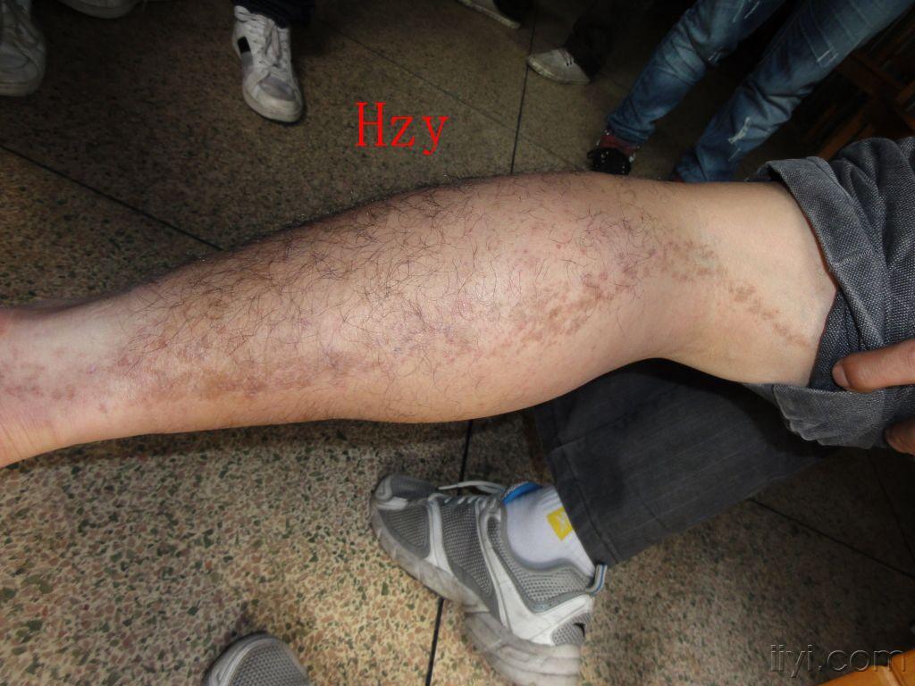 左下肢皮损一年余,无自觉症状----------线状扁平苔藓
