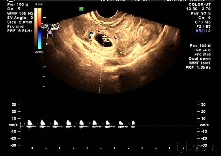 超声诊断典型的异位妊娠zengerya
