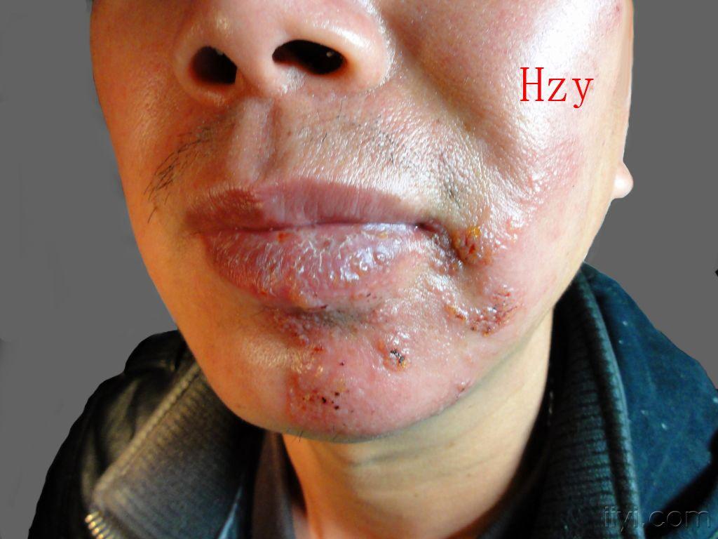 左侧口腔及脸部皮损五天----------带状疱疹.