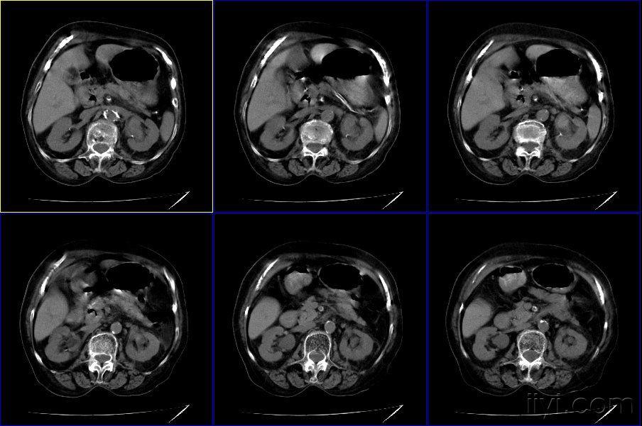 双肾ct请各位老师指导