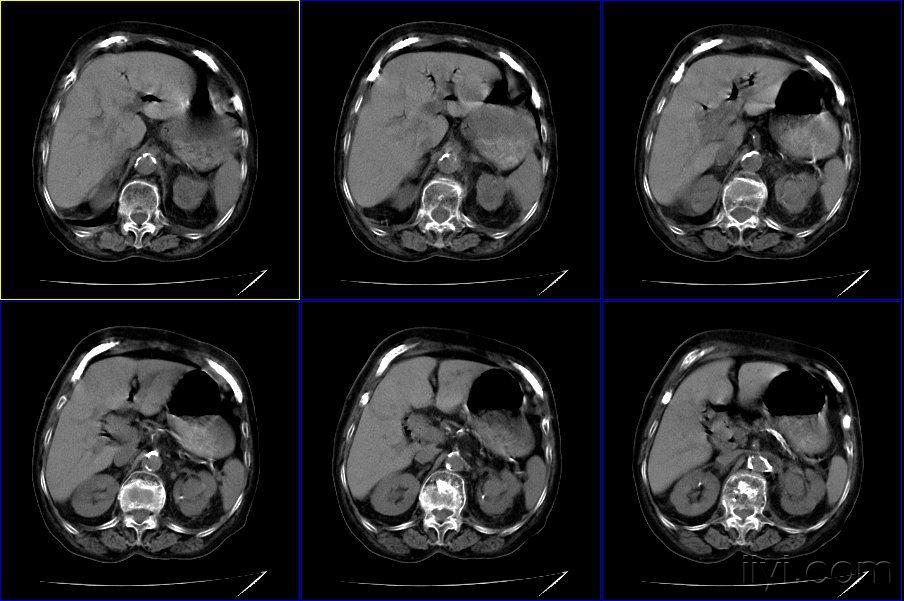 双肾ct请各位老师指导