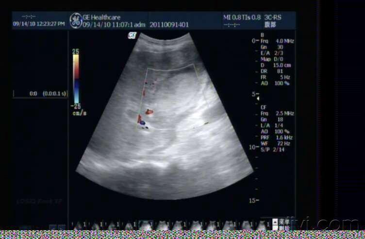 胆囊癌 超声医学讨论版 爱爱医医学论坛