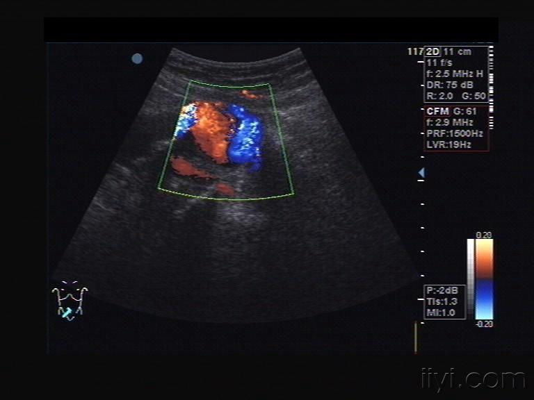 髂总动脉假性动脉瘤 - 超声医学讨论版 - 爱爱医医学论坛