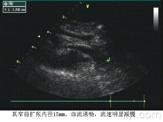 胡桃夹综合征 - 超声医学讨论版 - 爱爱医医学论坛