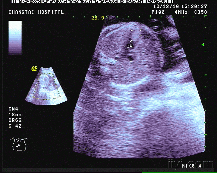胎儿心脏横纹肌瘤?