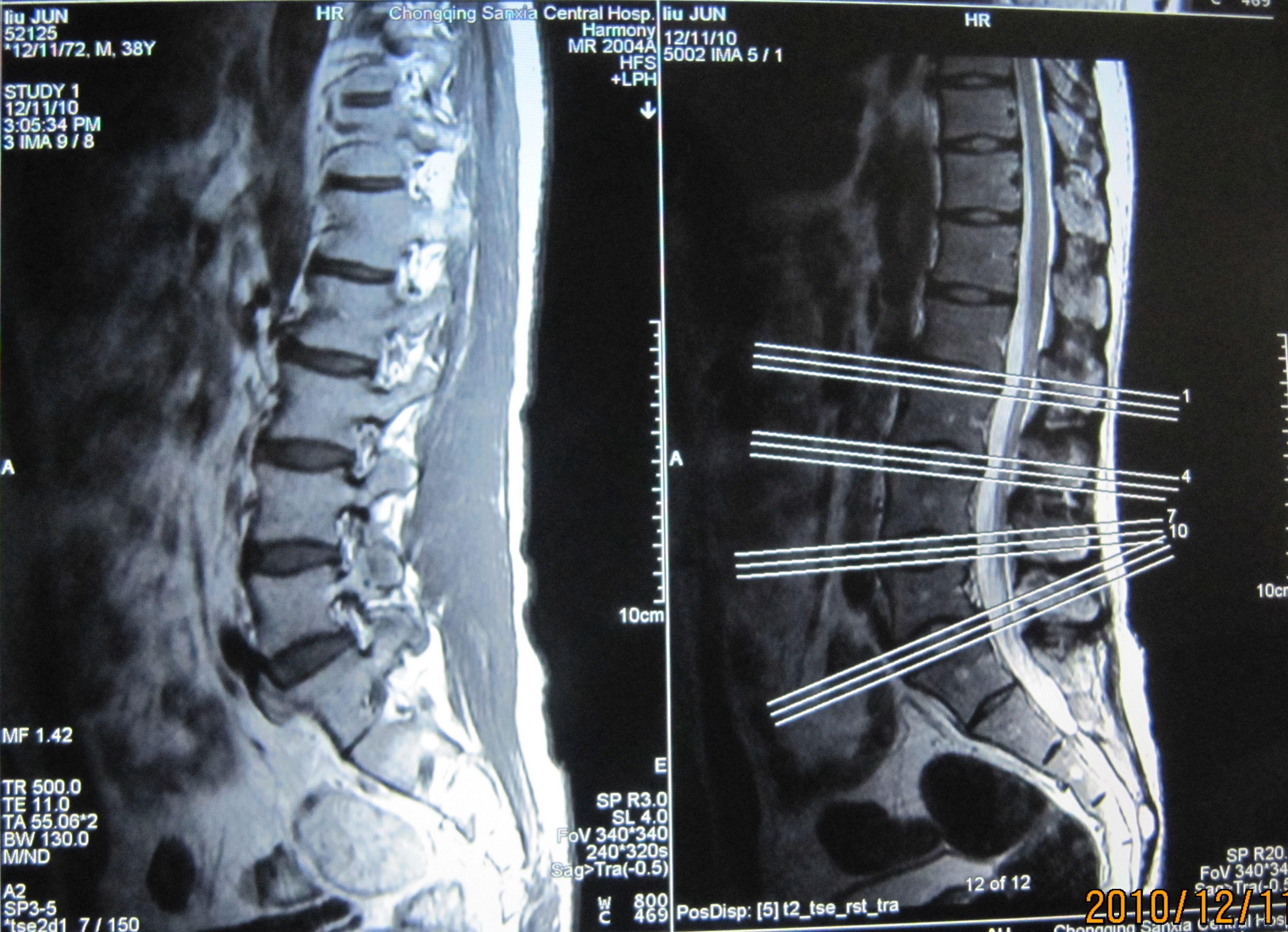请老师帮我看下胸腰椎核磁共振片