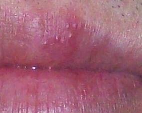 口唇上疱疹(上图)