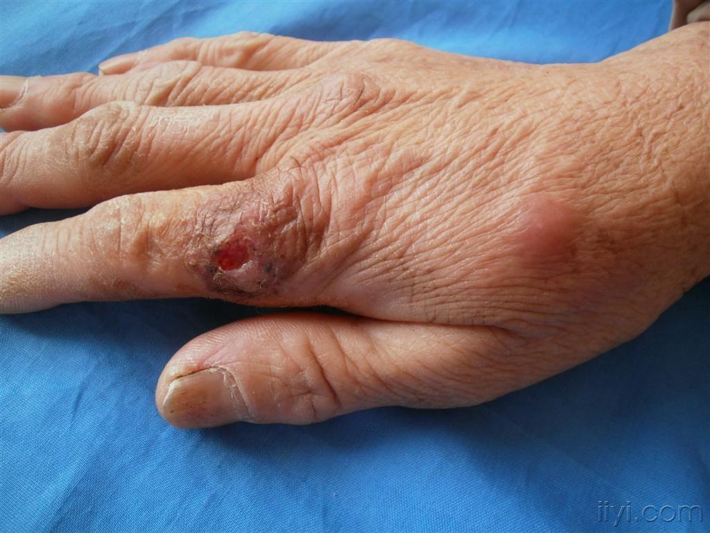 女,60岁.手指,手背结节溃疡1个月.自述劳动时轻微划伤后.