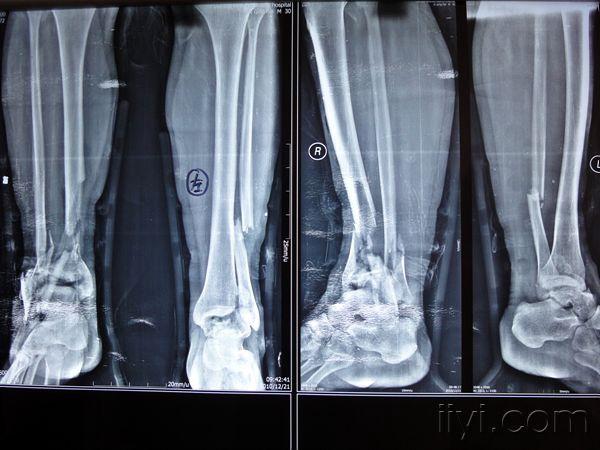 4米高处坠落伤,双下肢合并腰椎骨折.右胫骨下端已经无法重建了.