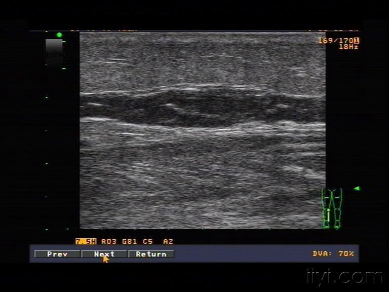 小腿腓肠肌肌间静脉血栓 超声医学讨论版 爱爱医医学论坛
