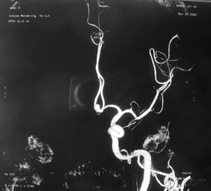 左前交通动脉瘤一例