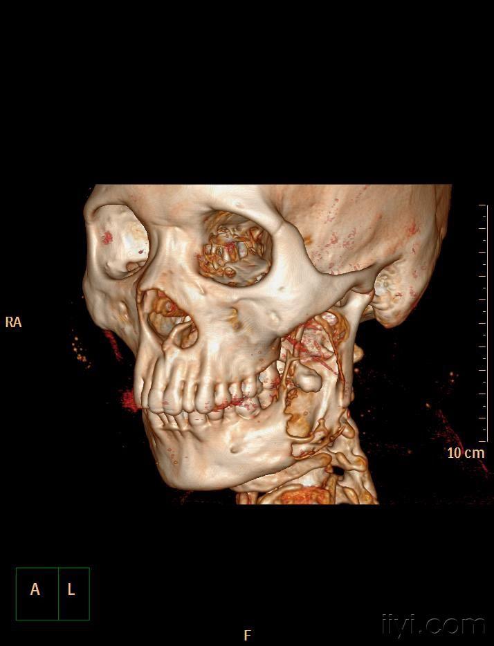 下颌骨病例 有病理 病理结果(造釉细胞瘤)