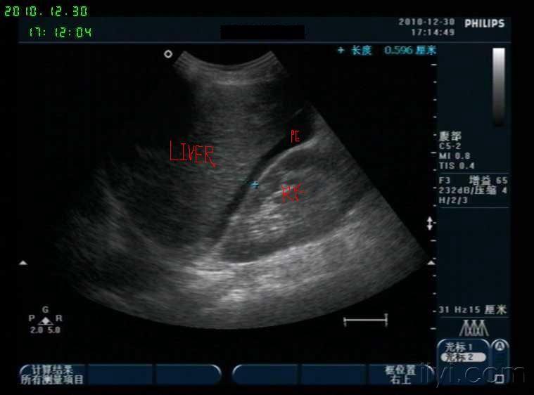肝内胆道及总胆管结石并肝左叶与腹壁之间窦道形成