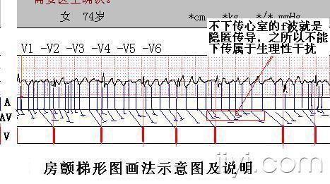 房颤梯形图及说明.jpg