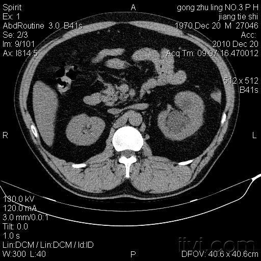 肾脏ct扫描请讨论