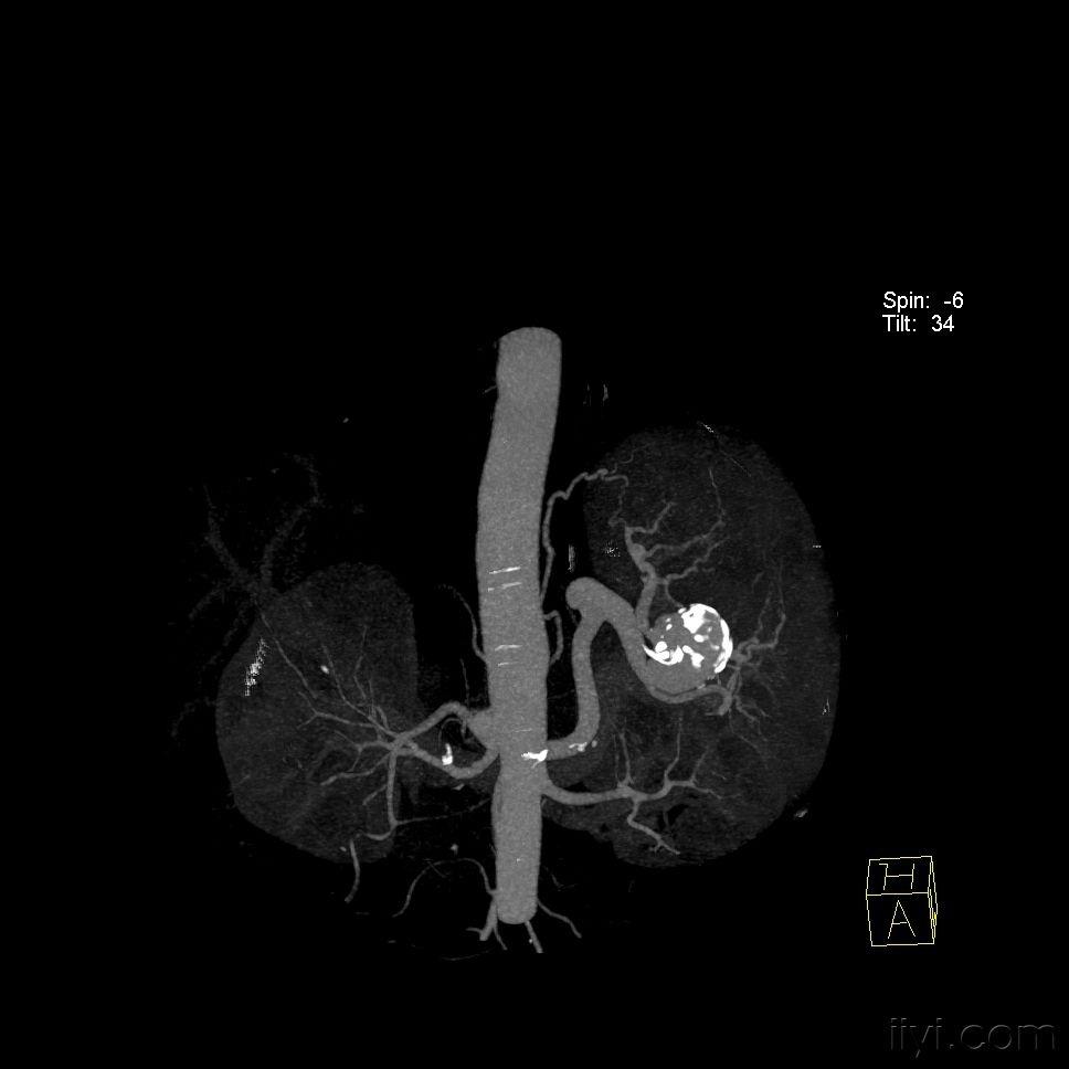 典型脾脏动脉瘤三维重建