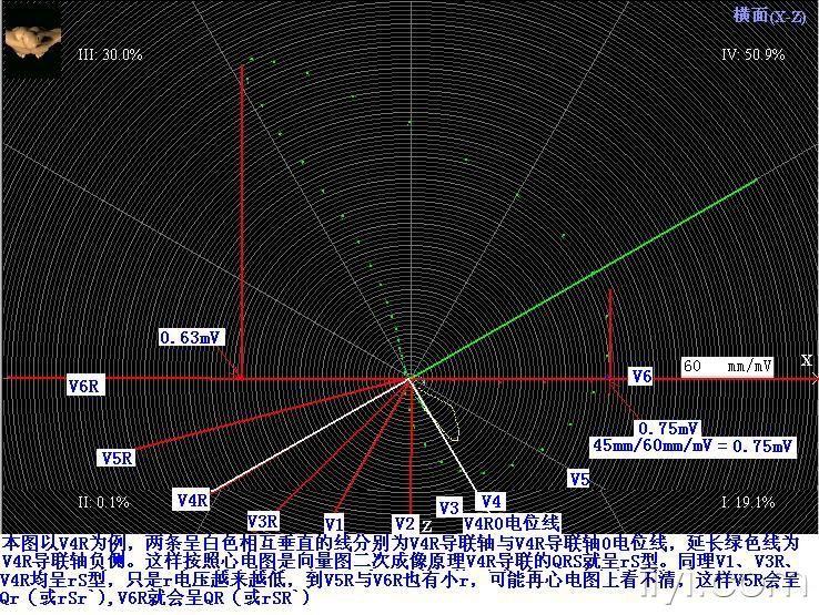 图一,男17岁-s1s2s3-顺钟向转为v3r-v5r导联qrs形态示意图.jpg