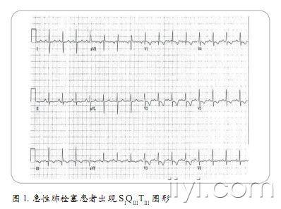 心电与临床心电图诊断acs的若干误区与新线索