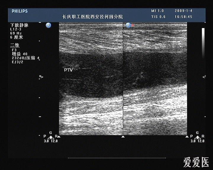 下肢静脉血栓 超声医学讨论版 爱爱医医学论坛