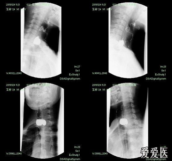 咽食管憩室