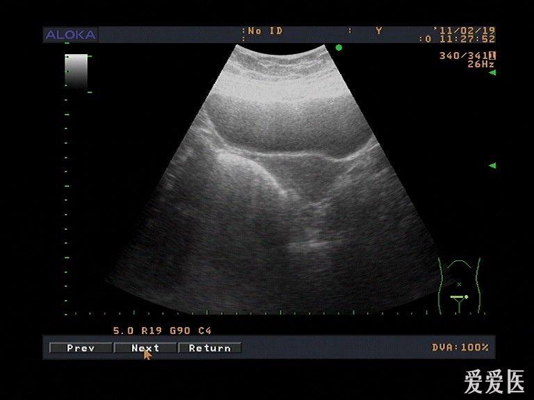 左侧腹壁子宫内膜异位症? - 超声医学讨论版 - 爱爱医医学论坛