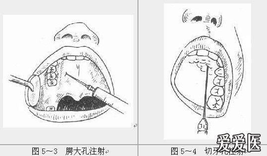 图5～3 腭大孔注射        图5～4 切牙孔注射