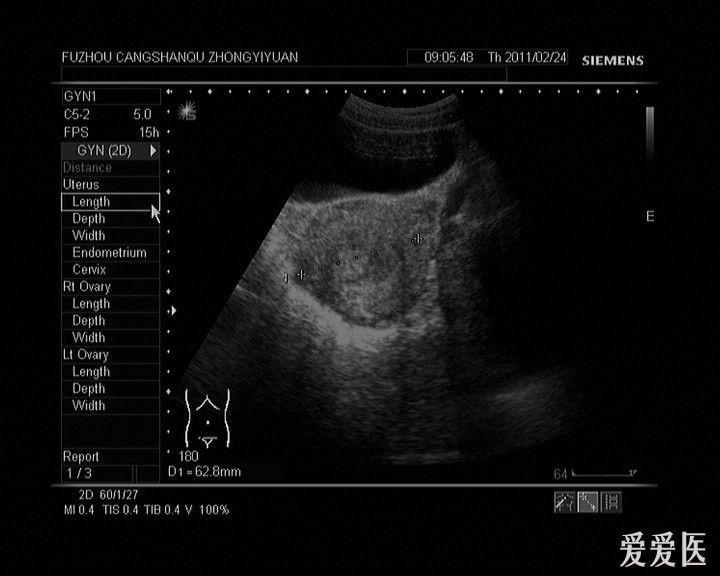 宫外孕图像 - 超声医学讨论版 - 爱爱医医学论坛