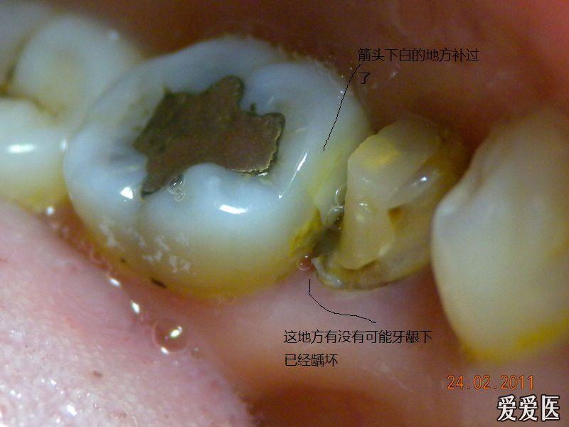 邻面龋可能牙龈下有龋坏,是否需要割牙龈,请大家给