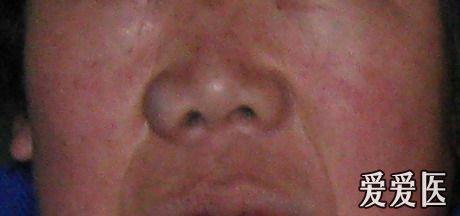 我岳母的鼻子的外侧长了个瘤,病理检查是血管瘤.附图如下.