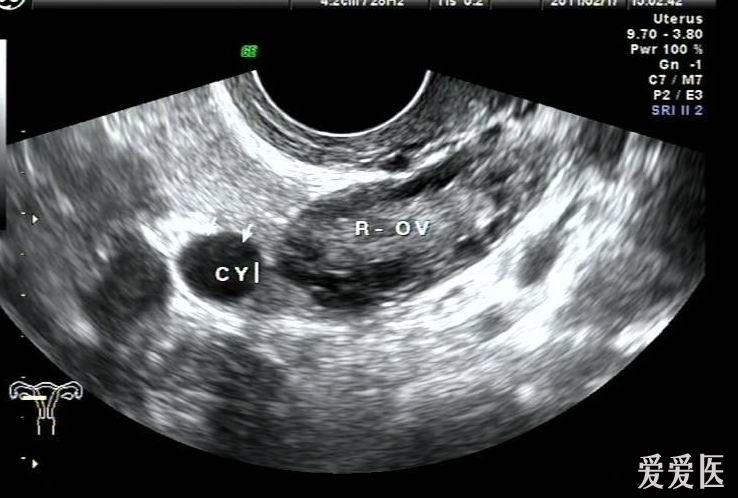 超声诊断输卵管系膜囊肿—zengerya二贴