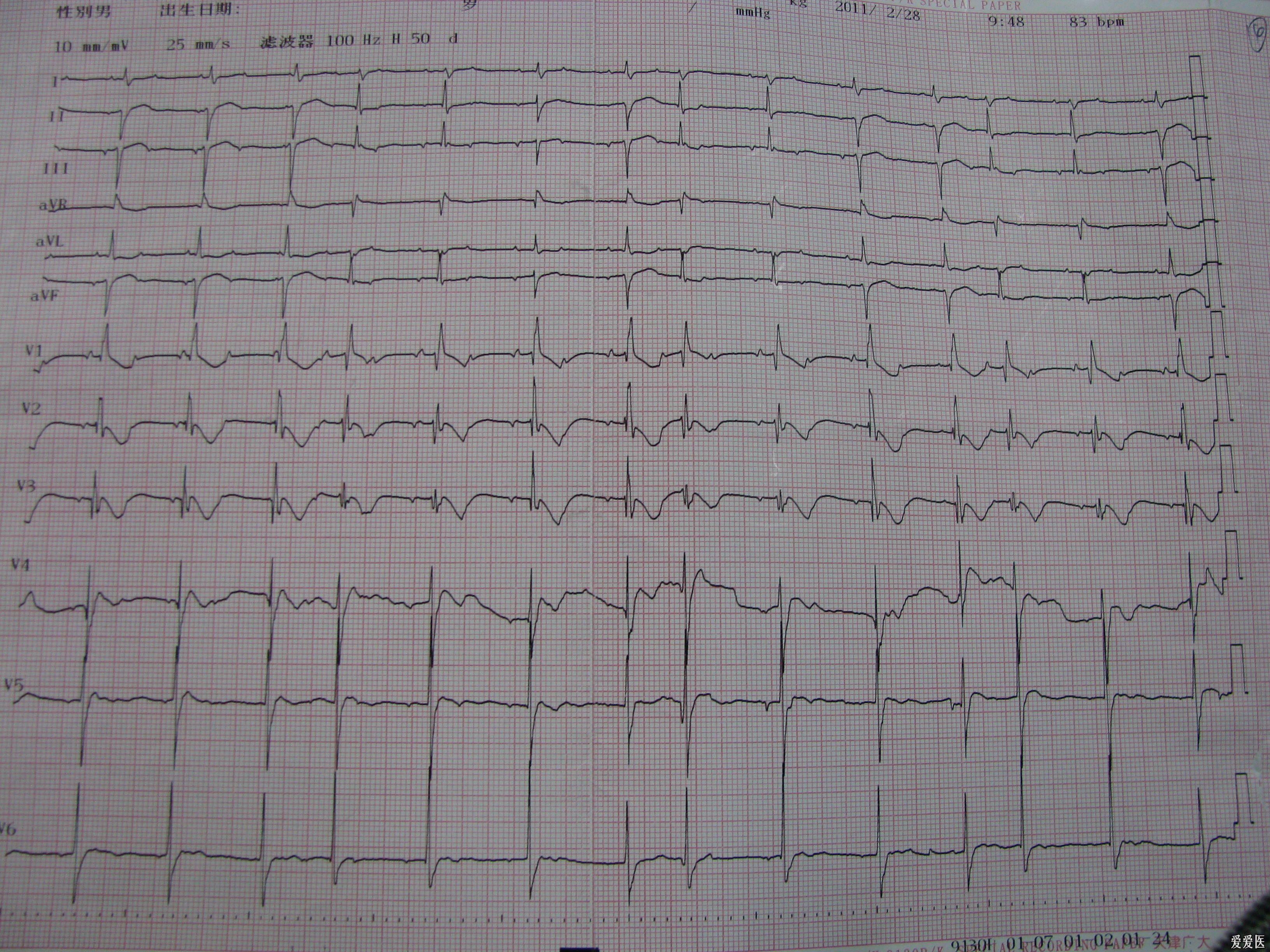 疑难心电图希望大家帮忙分析