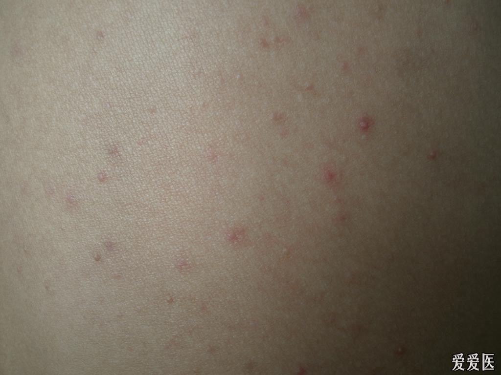马拉色菌性毛囊炎