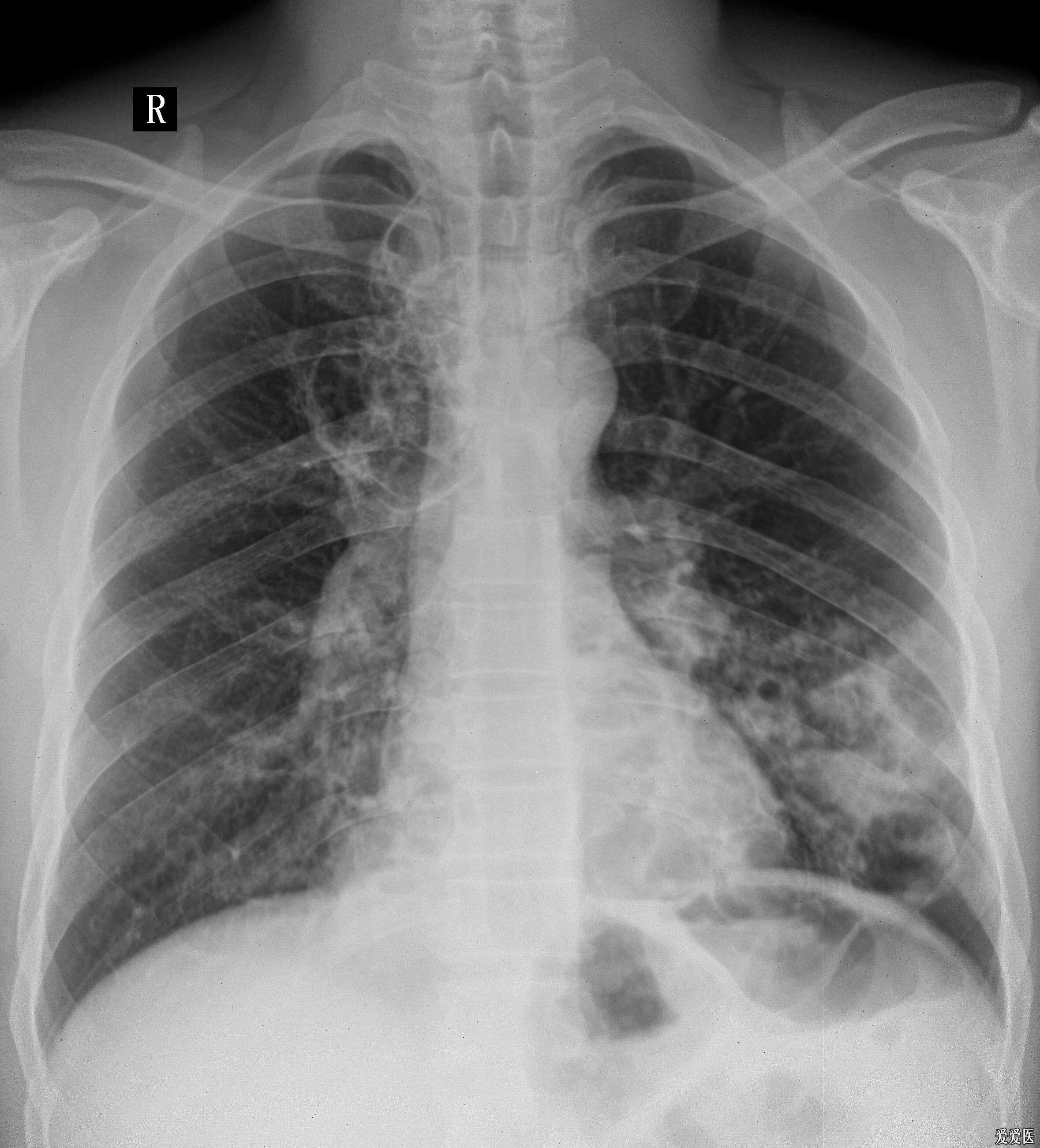 胸部正位dr片双肺多发透亮影