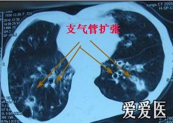 考虑:   1,肺结核   2,支气管扩张   3,慢性支气管炎伴感染,肺气肿