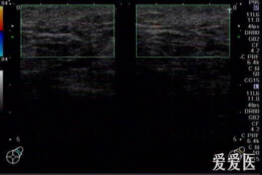 典型的副乳并囊肿 - 超声医学讨论版 - 爱爱医医学论坛
