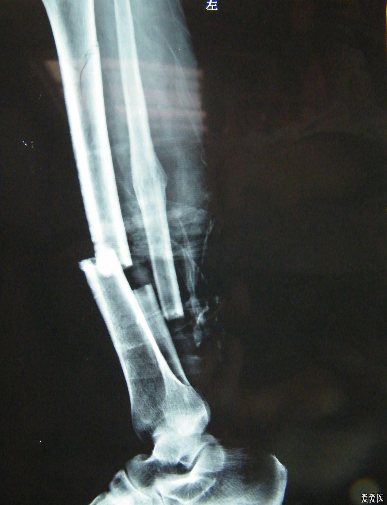 大腿骨近位部骨折の治療｜整形外科｜千船病院【大阪市】
