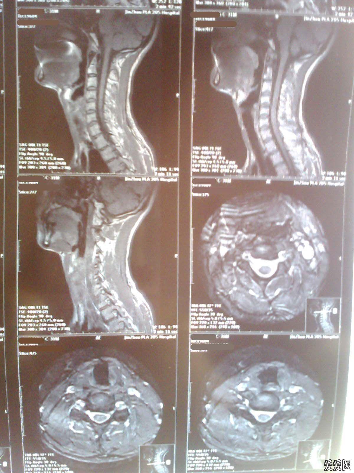 请医生看一下颈椎ct片和核磁片,确诊一下这是什么病,应该如何治疗?