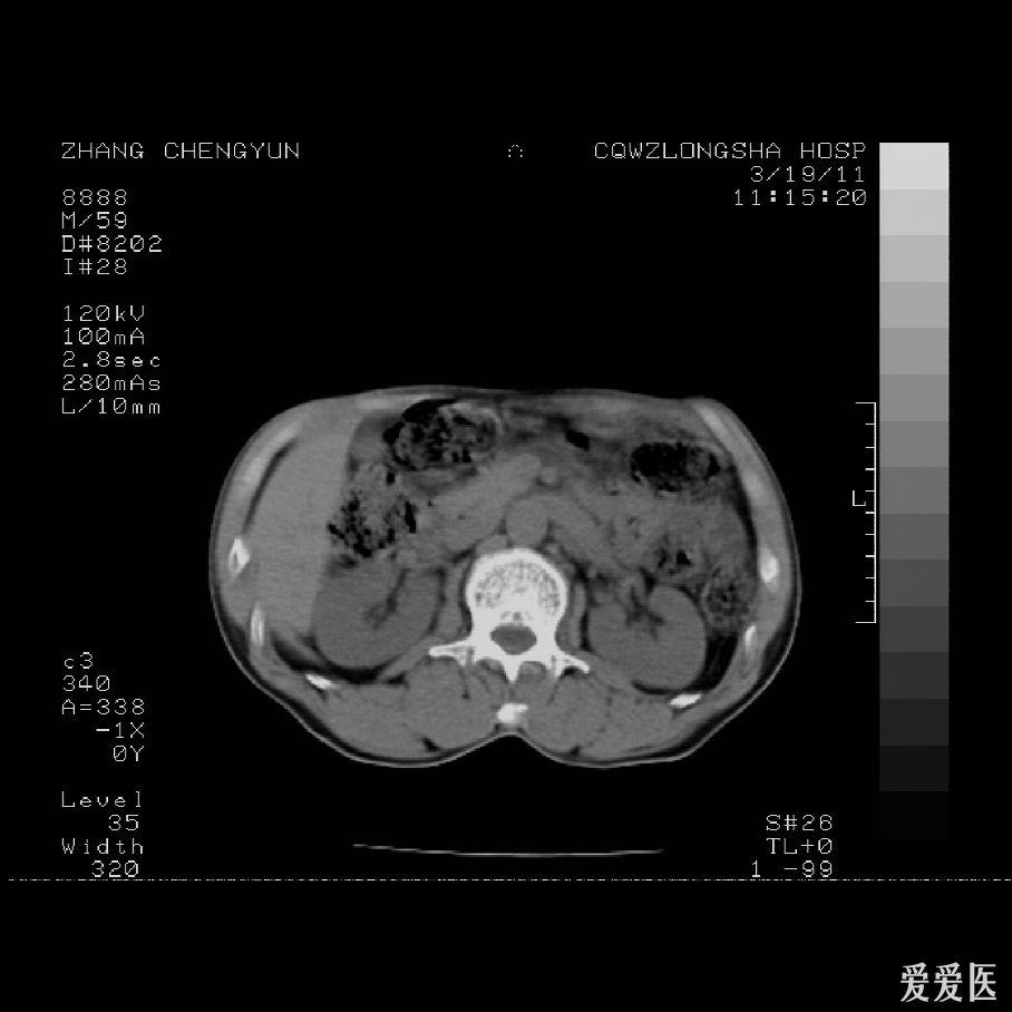 恳求各位高手细心解答:胸,上腹ct平扫,急!