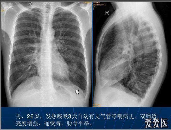 问问啊问问关于肺气肿的膈肌标准