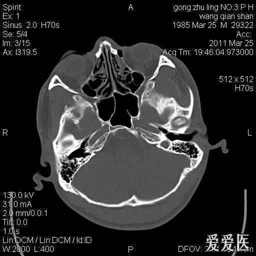 右侧筛窦骨瘤