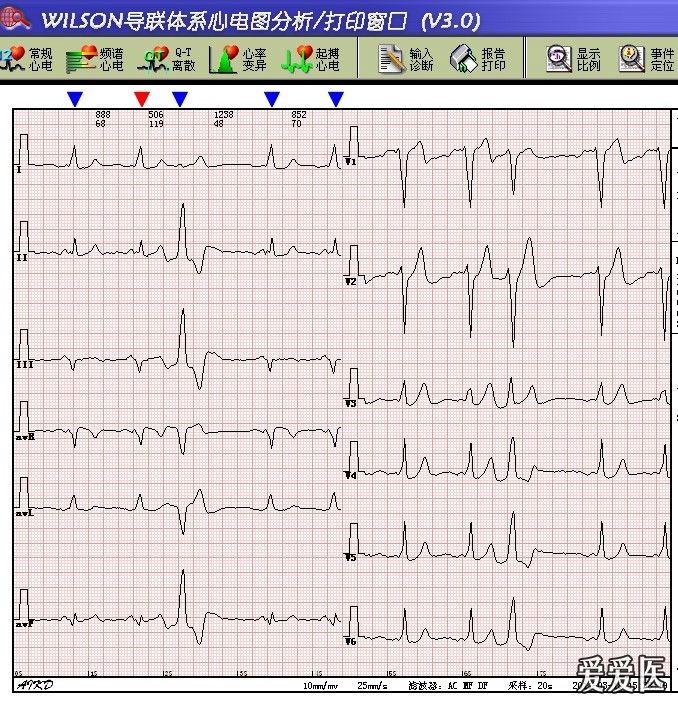 正常窦性心率心电轴显著左偏,频发性室性早搏,预激综合症st轻度压低