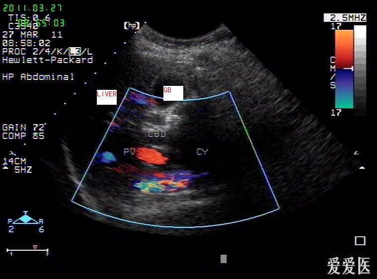胆总管囊肿并结石 - 超声医学讨论版 - 爱爱医医学论坛