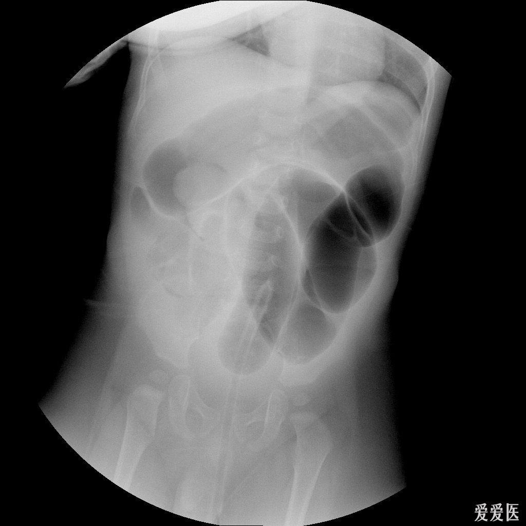 肠套叠空气灌肠复位2例 医学影像学讨论版 爱爱医医学论坛