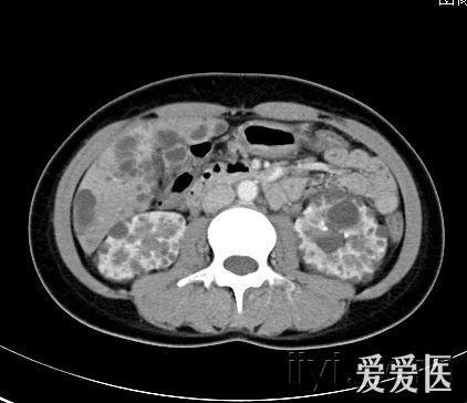 典型多囊肝多囊肾