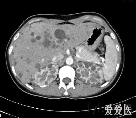 典型多囊肝多囊肾