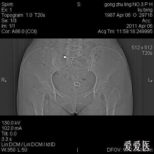 看看这个耻骨改变!