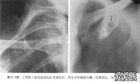 肋骨的正常变异,很容易误诊的